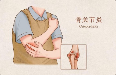 生活中怎樣預(yù)防骨關(guān)節(jié)炎？