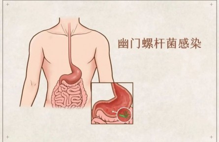 辟謠 | 吃大蒜能殺幽門螺桿菌？真的假的？