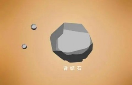 辟謠|腎結(jié)石患者不能補鈣？菠菜燉豆腐都不能吃了？