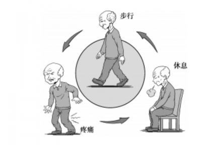 健康問(wèn)答|什么是間歇性跛行？